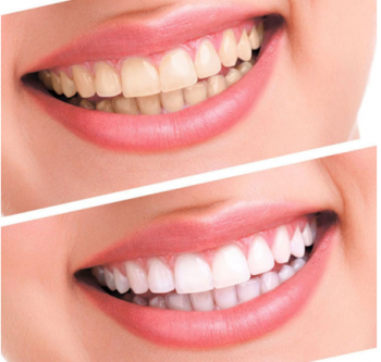 Teeth Whitening Kit Bleaching …