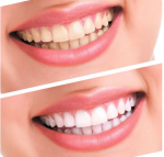 Teeth Whitening Kit Bleaching System Bright White Smiles Teeth Whitening Gel Kit With LED Light Professional